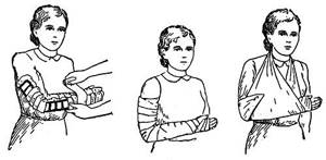 Шина Крамера при переломе: особенности конструкции, показания и правила к применению, техника и последовательность наложения на разные части тела
