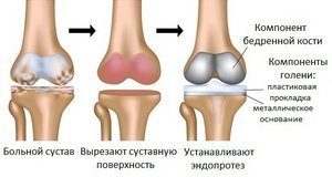 Эндопротез коленного сустава: типы и их особенности, лучшие производители и модели, сроки эксплуатации и цены