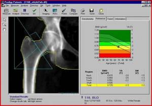 Денситометрия костей: показания к диагностике, как подготовиться к процедуре, особенности проведения обследования, расшифровка результатов