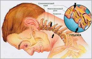 Тошнота при остеохондрозе шейного отдела: причины и симптомы, первая помощь и последующее лечение патологии, возможные осложнения и последствия