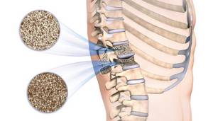 Остеопения и остеопороз — в чем разница заболеваний: почему кости слабеют, как восстановить, витамины, упражнения, рекомендации врачей,