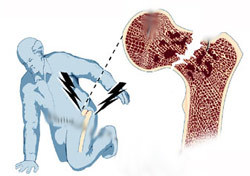 Деротационный сапожок при переломе шейки бедра: виды, материалы производства, польза, особенности использования, правила выбора фиксирующих приспособлений