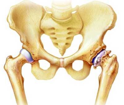 Остеопороз тазобедренного сустава: причины и признаки появления патологии, степени и способы борьбы с болезнью, лекарства и гимнастика