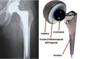 Эндопротез тазобедренного сустава: виды имплантов и способы фиксации, схема расположения и стоимость протеза, обзор лучших
