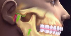 Вывих челюсти: алгоритм действий, первая помощь, лечение, использование фиксирующих повязок, реабилитация и восстановление в домашних условиях