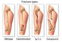 Перелом ладьевидной кости: классификация и причины повреждения, характерные симптомы и методы лечения, первая помощь и этапы реабилитации, возможные осложнения
