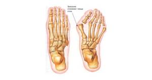Удаление косточки на большом пальце ноги лазером: суть лазеротерапии, плюсы и минусы метода, показания и противопоказания, восстановительный период