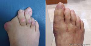 Шишка на мизинце ноги: фото, основные способы борьбы с недугом, причины и возможные заболевания