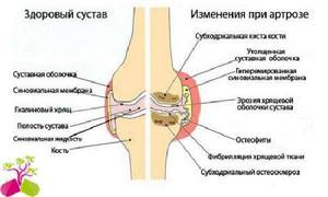 Болит колено при сгибании и разгибании: самая распространенная причина, воспалительные патологии и способы снятия болевого синдрома, методы терапии и диагностики патологии