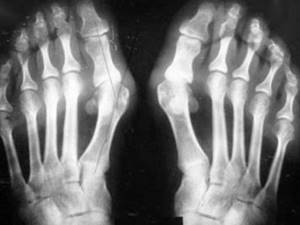Вальгусная деформация большого пальца стопы (hallux valgus): причины и механизм развития патологии, симптомы и методы диагностики, современные и народные методы лечения