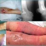 Посттравматический остеомиелит: клинические проявления и признаки заболевания, современные способы терапии и диагностические мероприятия, препараты и хирургическое вмешательство