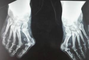 Лечение вальгусной деформации большого пальца стопы без операции: причины и особенности искривления, альтернативные способы исправления в домашних условиях