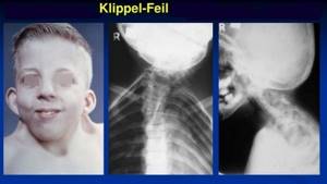 Синдром Клиппеля-Фейля: особенность патологии и причины ее развития, характерные симптомы и диагностика, методы лечения и возможные осложнения, прогноз для жизни