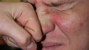 Перелом носа: классификация и отличительные симптомы травмы, правила оказания первой помощи и особенности лечения, последствия и реабилитация