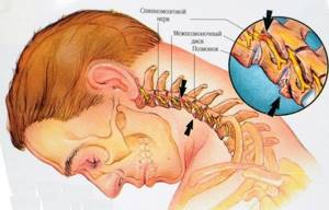 Как болит голова при шейном остеохондрозе: типы боли при заболевании, причины ее появления и отличие от мигрени, методы лечения и профилактики