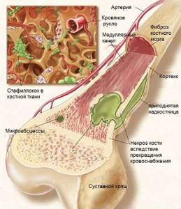 Остеонекроз: заболевания костей, суставов и мышц, причины заболевания, симптомы и способы лечения
