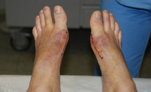 Удаление косточки на большом пальце ноги: причины появления, плюсы и минусы хирургического метода, показания и противопоказания к операции