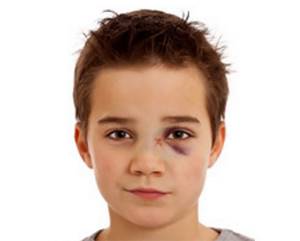 Перелом носа у ребенка: классификация и причины повреждения, первичные и вторичные признаки травмы, оказание первой помощи и методы лечения, возможные осложнения