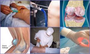 Киста Бейкера коленного сустава: особенности патологии, виды, размеры для проведения операции, подготовка к хирургическому вмешательству, реабилитация