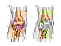 Артрит локтевого сустава: характерные черты и осложнения недуга, признаки и причины патологии, клиническая картина болезни