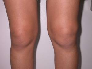 Двухсторонний гонартроз коленных суставов 2 степени: виды и развитие заболевания, симптомы и клиническая картина, особенности диагностики и лечения болезни