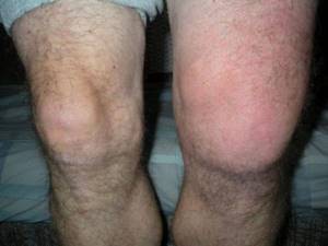 Воспаление коленного сустава: факторы риска и причины патологии, специфические симптомы и диагностика, консервативные и хирургические методы лечения, народные рецепты