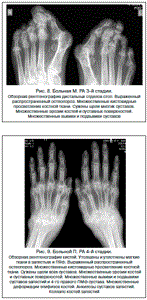 Рентген стадии ревматоидного артрита по признакам и активности: описание патологии и степени активности процесса, виды деформации на снимке