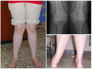 Варусная деформация коленных суставов: причины и симптомы заболевания, медикаментозные и народные методы лечения, способы профилактики и осложнения