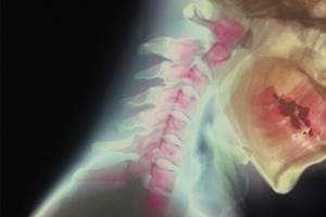 Перелом шеи: классификация травмы, характерные симптомы и методы диагностики, меры первой помощи и способы лечения, реабилитационный период и сроки восстановления