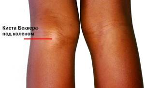 Лечение кисты Бейкера коленного сустава народными средствами: рецепты для наружного применения и для приема внутрь, противопоказания к терапии и прогноз на выздоровление