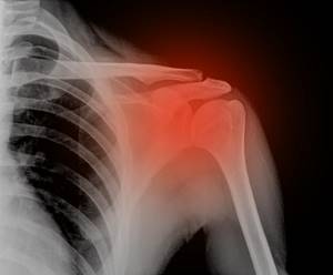 Перелом плечевой кости: классификация травм, симптомы, первая помощь пострадавшему, методы диагностики и принципы лечения, реабилитационные мероприятия и профилактика