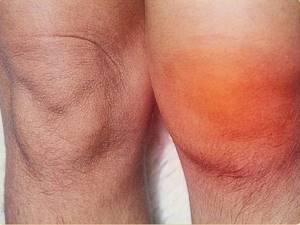 Болит колено при сгибании и разгибании: самая распространенная причина, воспалительные патологии и способы снятия болевого синдрома, методы терапии и диагностики патологии