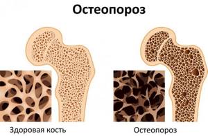 Уколы от остеопороза: особенности проведения иньекций, обзор препаратов и их описание, названия самых эффективных лекарств