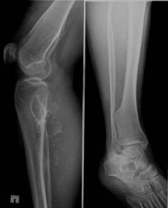 Саркома коленного сустава: причины возникновения, стадии, симптомы, методы диагностики, лечение с помощью хирургического вмешательства и химиотерапии