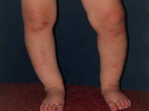 Ноги колесом у ребенка: осложнения и последствия, причины деформации и симптомы, методы лечения и профилактики, ортопедические варианты
