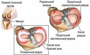 Лфк и упражнения при травме мениска коленного сустава: периоды реабилитации, комплекс тренировок и правила проведения лечебной физкультуры, рекомендации пациентам
