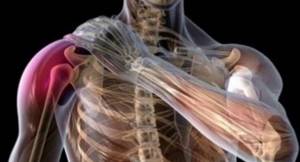 Неврит плечевого нерва: причины патологии, характерные симптомы и методы диагностики, лечение препаратами и народными средствами, возможные осложнения и прогноз