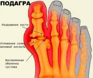 Народные средства для лечения подагры на ногах: причины возникновения, симптомы, правила использования фитотерапии, компрессов и ванночек для профилактики