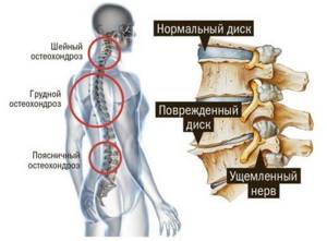 Смещение позвонков грудного отдела: симптомы и лечение - Сайт об опорно двигательной системе человека