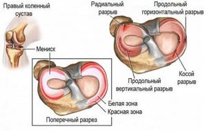 Мениск коленного сустава: разновидности, особенности строения и функции хрящевого образования, возможные повреждения и методы их лечения, осложнения травм