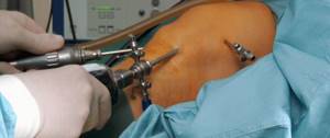 Артротомия сустава: показания и противопоказания к операции, виды вмешательства и механизм проведения процедуры, послеоперационный период и возможные осложнения