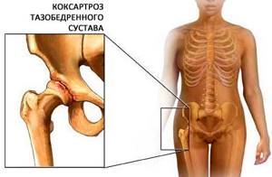 Хруст в тазобедренном суставе: возможные патологии, чем это опасно и что делать, способы диагностики и лечения