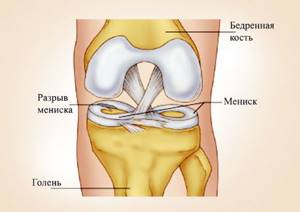 Реабилитация после операции на мениске коленного сустава: особенности и реабилитация, показания к выполнению операции, послеоперационный стационарный период