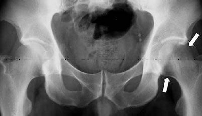 Остеопороз тазобедренного сустава: причины и признаки появления патологии, степени и способы борьбы с болезнью, лекарства и гимнастика