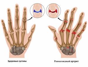 Воспаление суставов кисти руки: провоцирующие факторы, причины и симптомы патологии, методы диагностики, лечение и профилактика средствами народной медицины