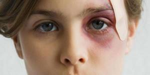 Мазь от синяков на лице: обзор эффективных препаратов, рассасывающие и разогревающие средства от гематом, противопоказания и меры предосторожности