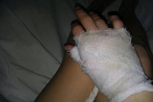 Ушиб кисти руки: отличие травмы от перелома, правила оказания первой помощи, лечение медикаментами и народными средствами, реабилитационные мероприятия