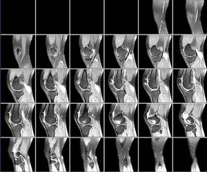 МРТ коленного сустава: показания и противопоказания к проведению диагностики, подготовка и процесс проведения процедуры, информативность и стоимость методики