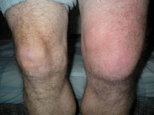 Мениск коленного сустава: разновидности, особенности строения и функции хрящевого образования, возможные повреждения и методы их лечения, осложнения травм