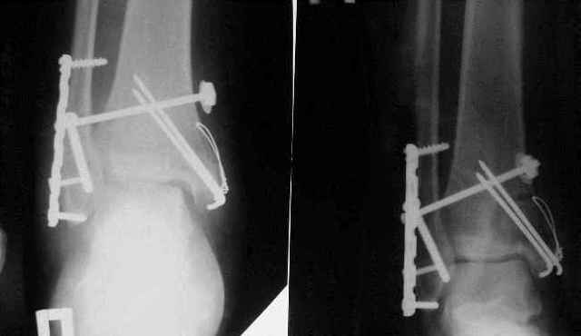 Операция при переломе лодыжки: особенности проведения, показания, реабилитационный период после хирургического вмешательства